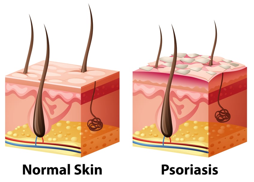 Taking Control of Psoriasis. Does Steam Help?